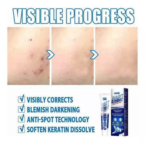 Instant Herbal Wart Remover Cream(100g)