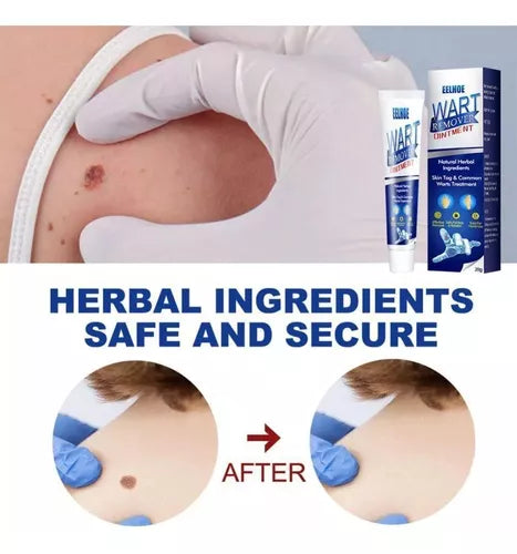 Instant Herbal Wart Remover Cream(100g)
